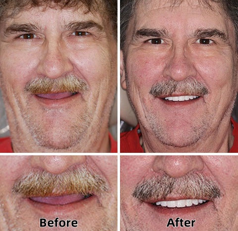 ✨Health America Subsidized Product✅LAOZIKTM-Advanced Custom-Fit Functional Dentures-Made in the USA & FDA-Certified