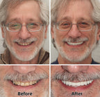 ✨Health America Subsidized Product✅LAOZIKTM-Advanced Custom-Fit Functional Dentures-Made in the USA & FDA-Certified