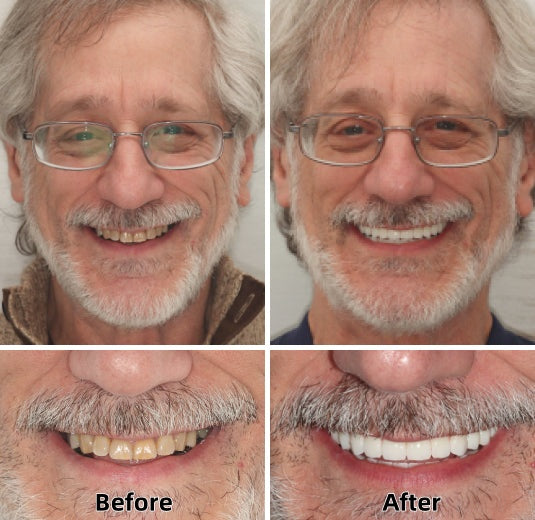 ✨Health America Subsidized Product✅LAOZIKTM-Advanced Custom-Fit Functional Dentures-Made in the USA & FDA-Certified