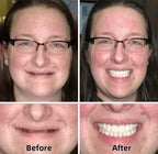 ✨Health America Subsidized Product✅LAOZIKTM-Advanced Custom-Fit Functional Dentures-Made in the USA & FDA-Certified