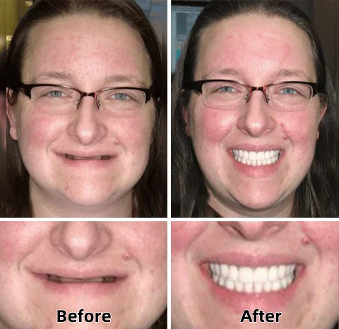 ✨Health America Subsidized Product✅LAOZIKTM-Advanced Custom-Fit Functional Dentures-Made in the USA & FDA-Certified