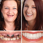 🦷🍎Heat and Fit ROSOPLTM – Immediate Dentures: The Ultimate Fit You Can’t Resist!  (👩‍🔬FDA Certified | Dentist Approved)