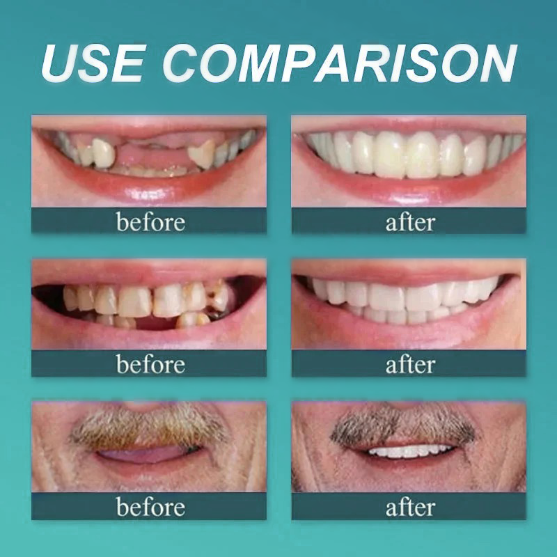 🦷🍎Heat and Fit ROSOPLTM – Immediate Dentures: The Ultimate Fit You Can’t Resist!  (👩‍🔬FDA Certified | Dentist Approved)
