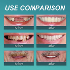 🦷🍎Heat and Fit ROSOPLTM – Immediate Dentures: The Ultimate Fit You Can’t Resist!  (👩‍🔬FDA Certified | Dentist Approved)